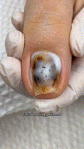 Close-up ad image of a severely discolored and damaged toenail.